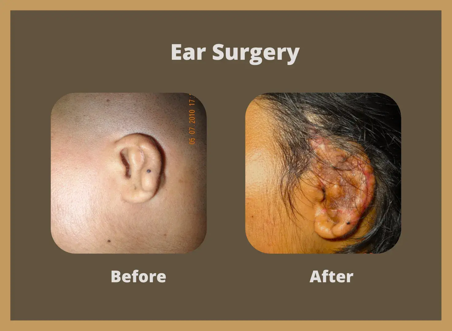 Ear-surgery-2