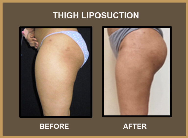 Thigh-Liposuction-2