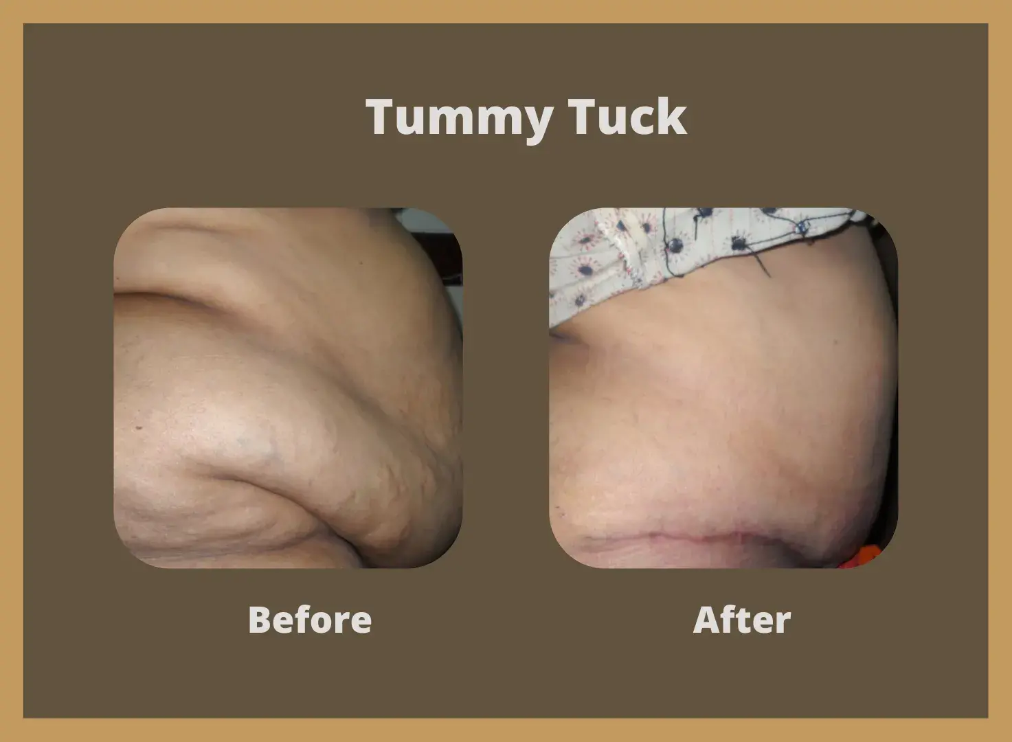 Tummy-Tuck-1