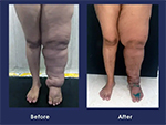 Lymphedema Surgery