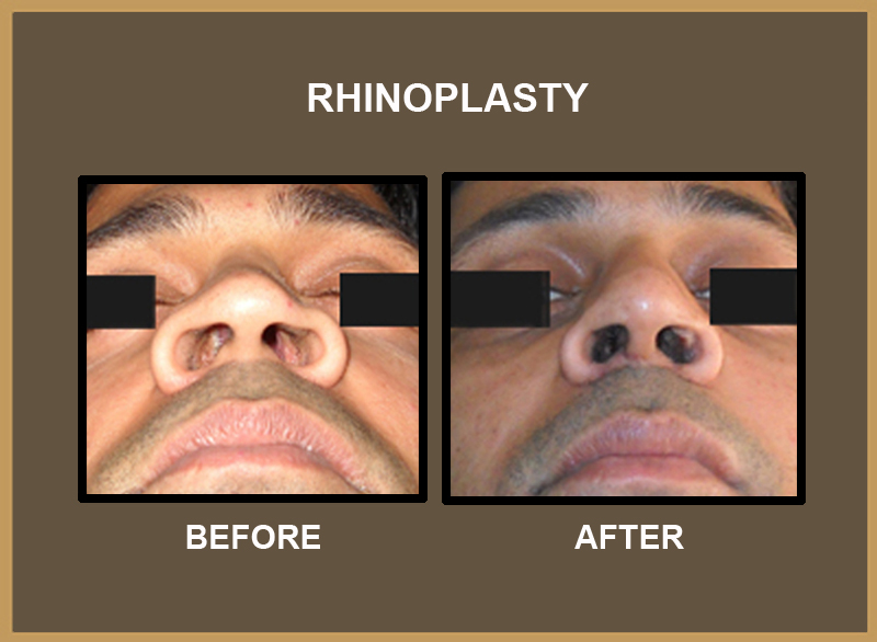 rhinoplasty-7