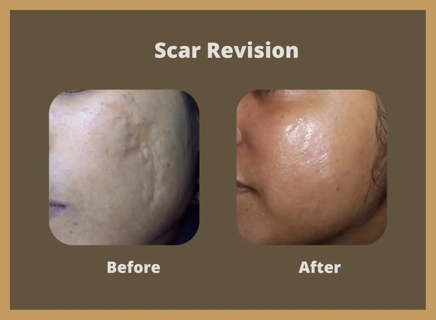 scar-revision-3