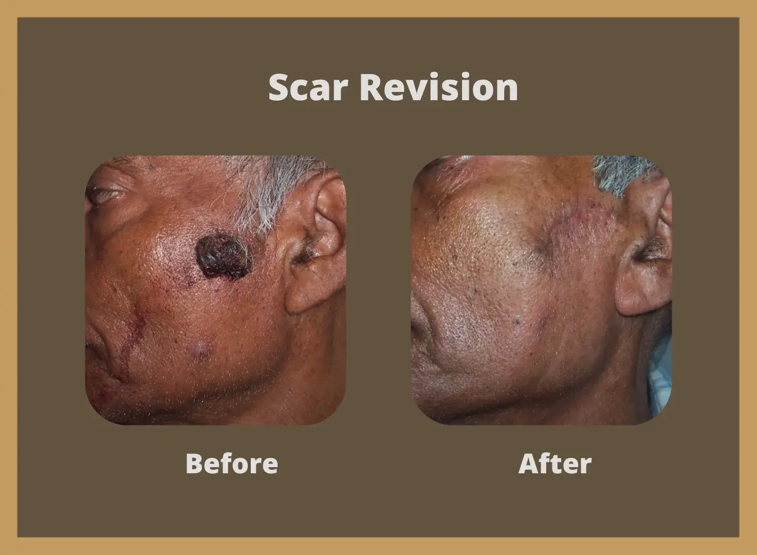 scar-revision