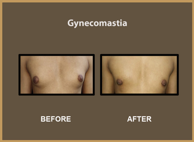 gynecomastia-5