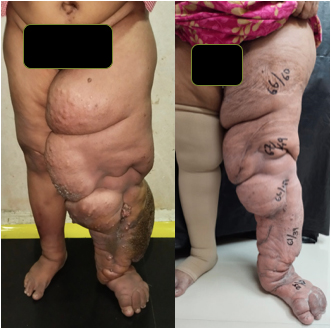 lymphedema-result-new