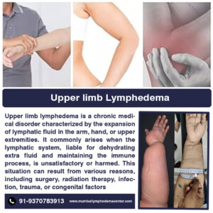 Upper Limb Lymphedema