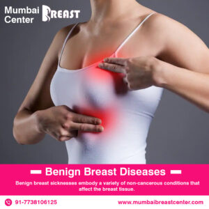 Benign Breast Diseases in Mumbai
