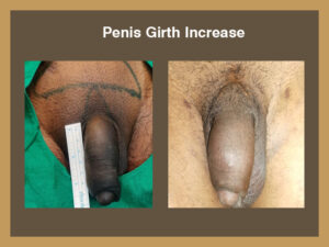 penile-girth-1
