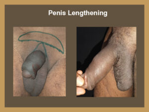 penile-lenghting-2