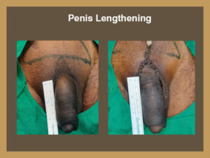 penile-lenghting-3