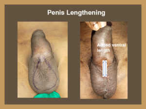 penile-lenghting-4