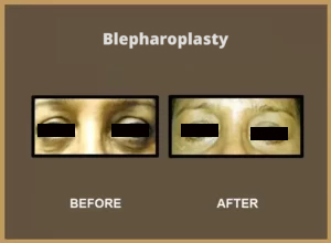 Blepharoplasty-1-300x220-1