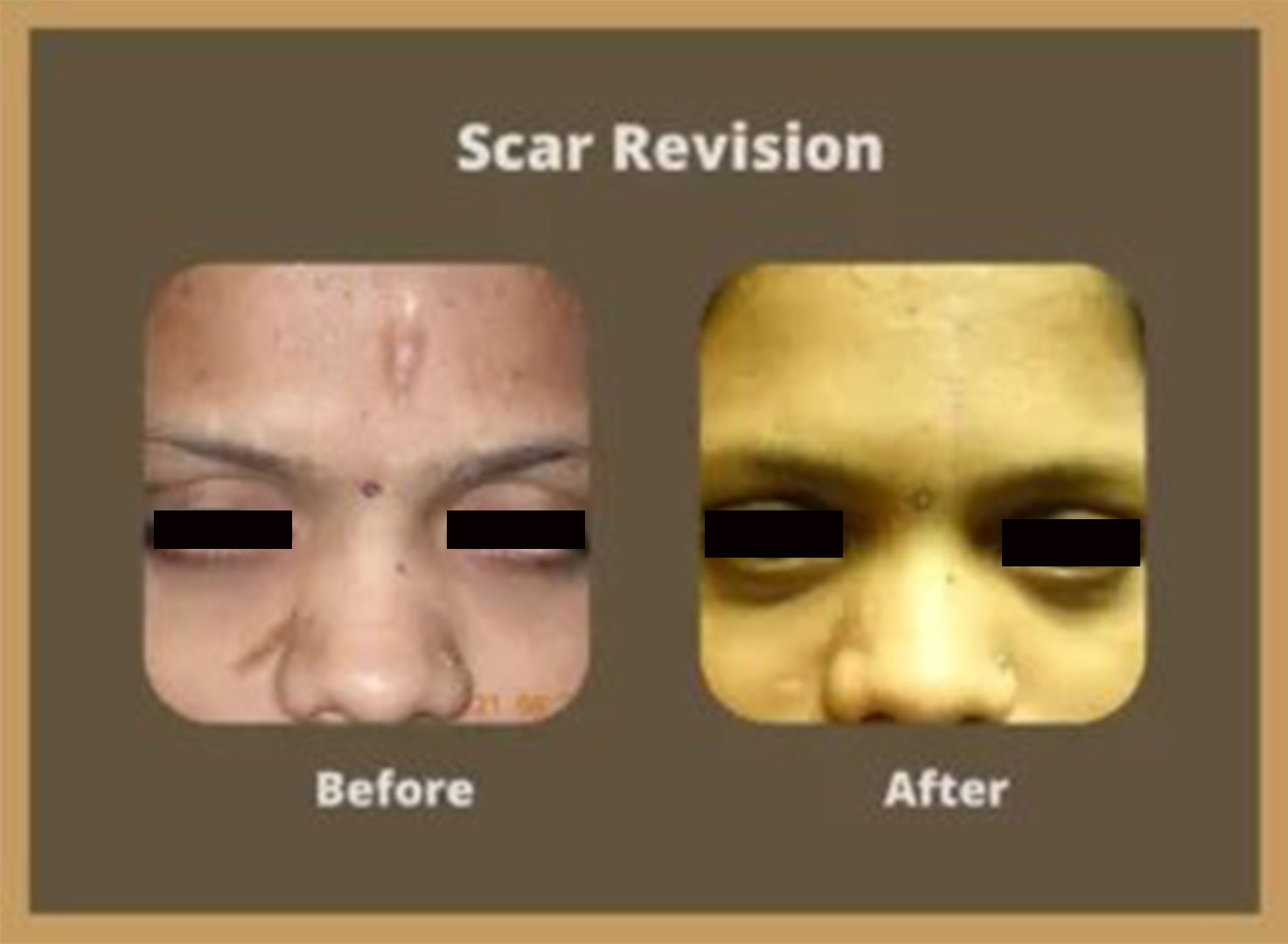 scar-revision-1-300x220