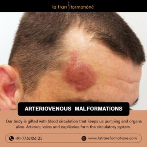 Arteriovenous Malformations